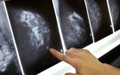 Sancionada lei que amplia acesso à mamografia pelo SUS a partir dos 40 anos.