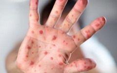 Casos de sarampo aumentam em Campos Lindos (TO); SES-TO reforça a importância da vacinação e isolamento para conter o surto.