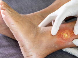 O objetivo do ambulatório é garantir atendimento especializado, seguro e humanizado aos pacientes portadores de feridas agudas e crônicas