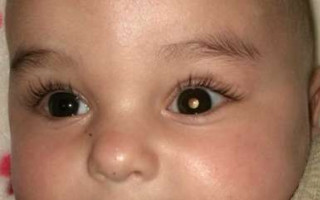  Reflexo esbranquiçado no olho é o principal sinal do retinoblastoma.