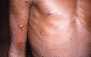 A varíola dos macacos é uma doença viral endêmica no continente Africano
