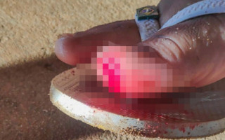 Vítima de ataque de piranha teve dedo do pé ferido enquanto estava na Praia do Prata