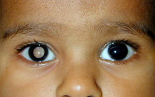 Retinoblastoma é uma doença que começa na retina e, sem tratamento adequado, pode comprometer a visão 