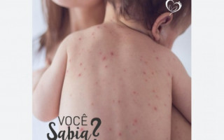 A SES-TO destaca que os casos registrados no Tocantins são o sexto e sétimo caso de sarampo no Brasil, em 2025, que já teve confirmações  no Distrito Federal (1), no Rio de Janeiro (2), em São Paulo (1) e no Rio Grande do Sul (1).
