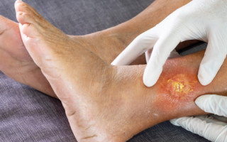 O objetivo do ambulatório é garantir atendimento especializado, seguro e humanizado aos pacientes portadores de feridas agudas e crônicas