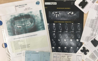Peritos médicos legais identificam em menos de 5h cadáver por arcada dentária em Dianópolis