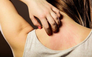 A dermatite de contato não é uma doença grave, mas os sintomas são bastante desconfortáveis.