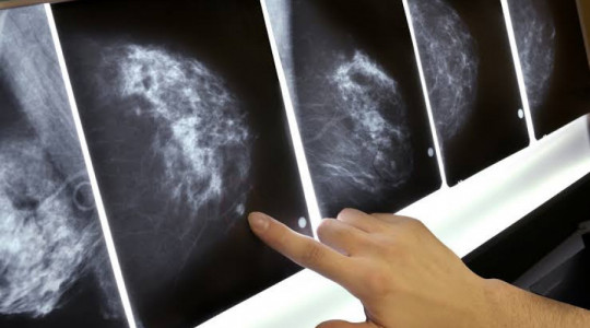 Sancionada lei que amplia acesso à mamografia pelo SUS a partir dos 40 anos.